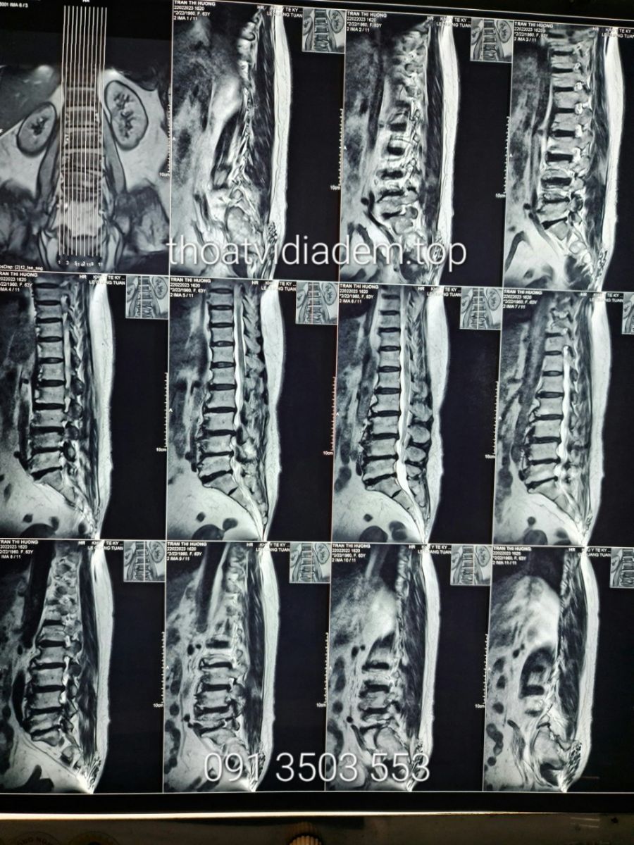 MRI thoát vị đĩa đệm cột sống thắt lưng.